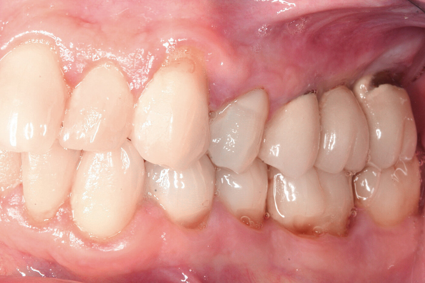 Geistlich USA Socket Seal