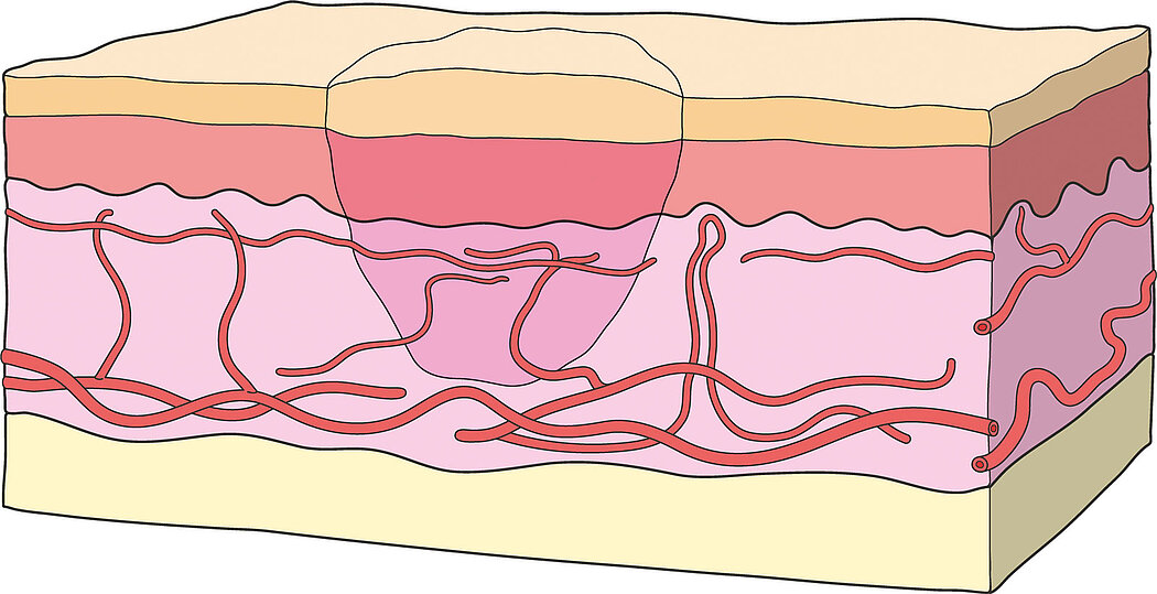 Illustration of the Healed Wound