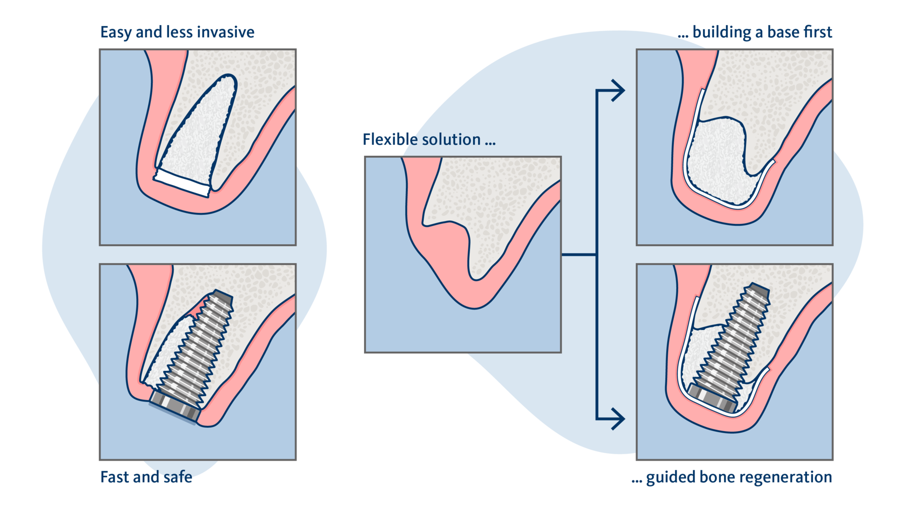Geistlich USA Dental Implants