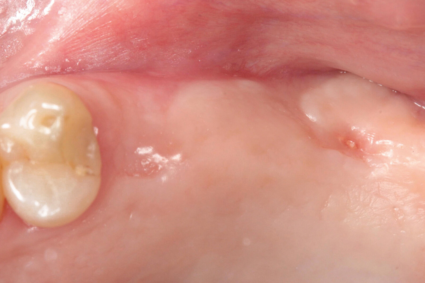 Geistlich USA Socket Seal