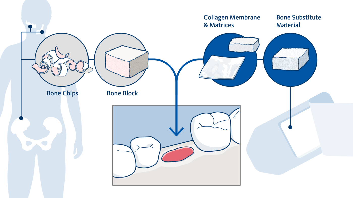 Geistlich USA Dental Implants