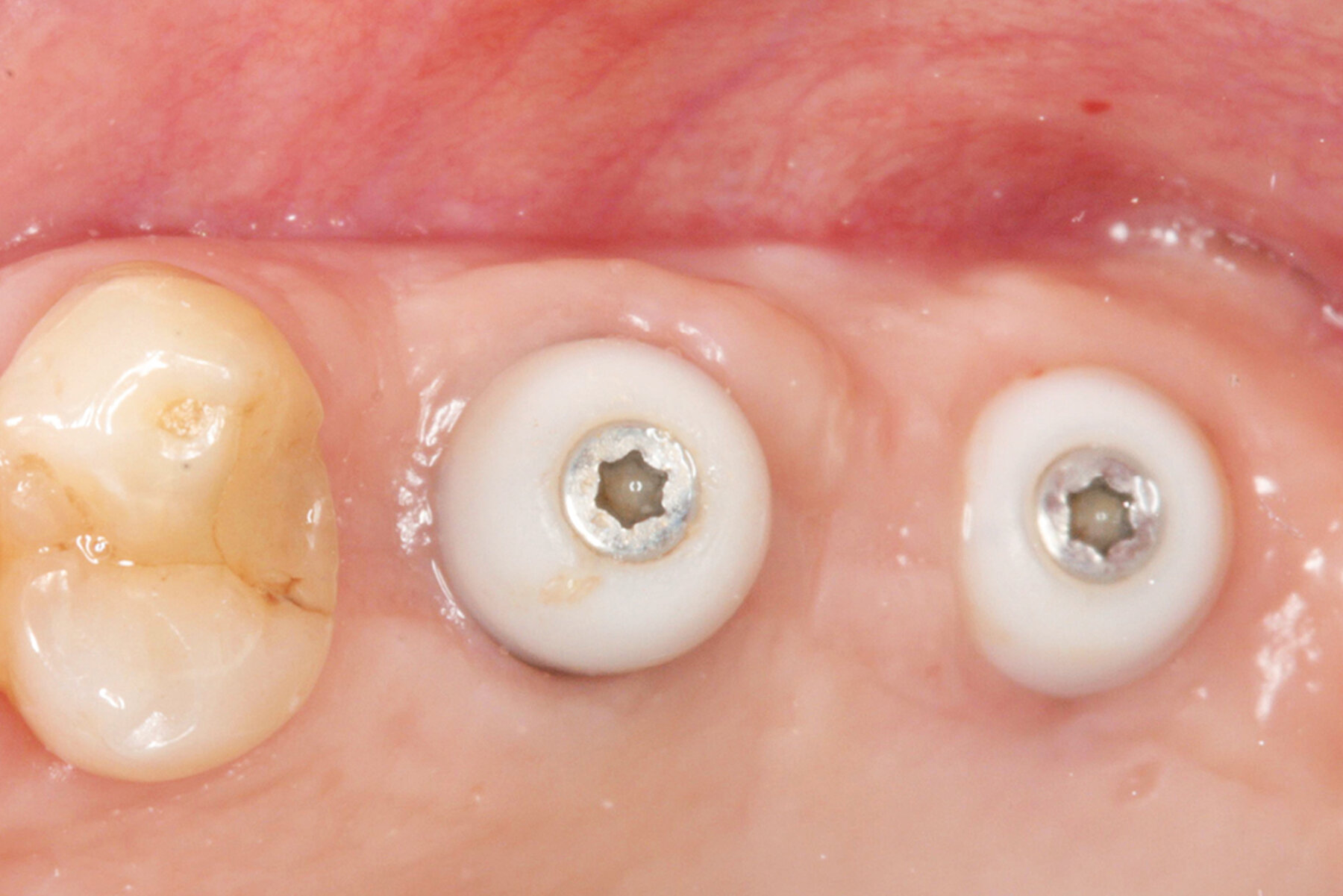 Geistlich USA Socket Seal