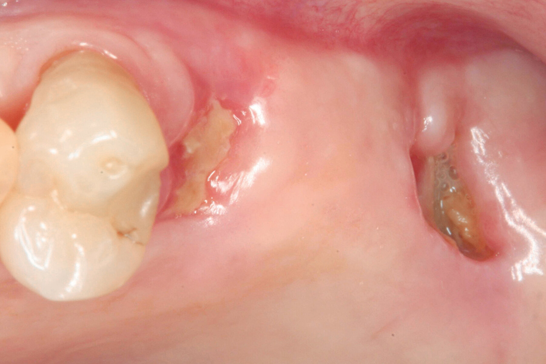 Geistlich USA Socket Seal