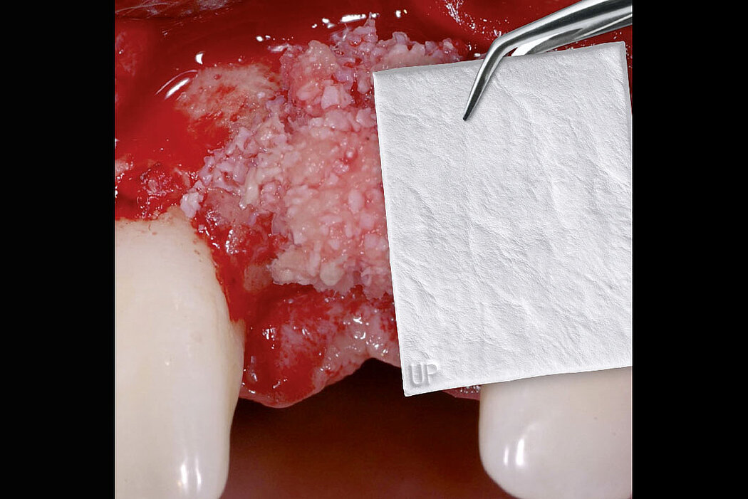 Minor Bone Augmentation 引导骨再生 (GBR, Guided Bone Regeneration) 的高预期性。(图片承蒙瑞士Dr. Ronald E. Jung提供)